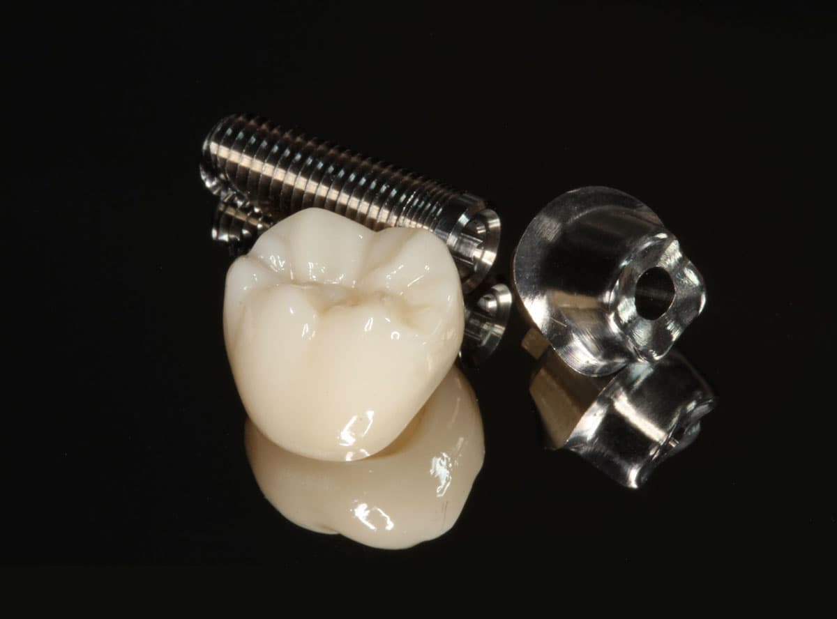 Cement-Retained Implant Crown