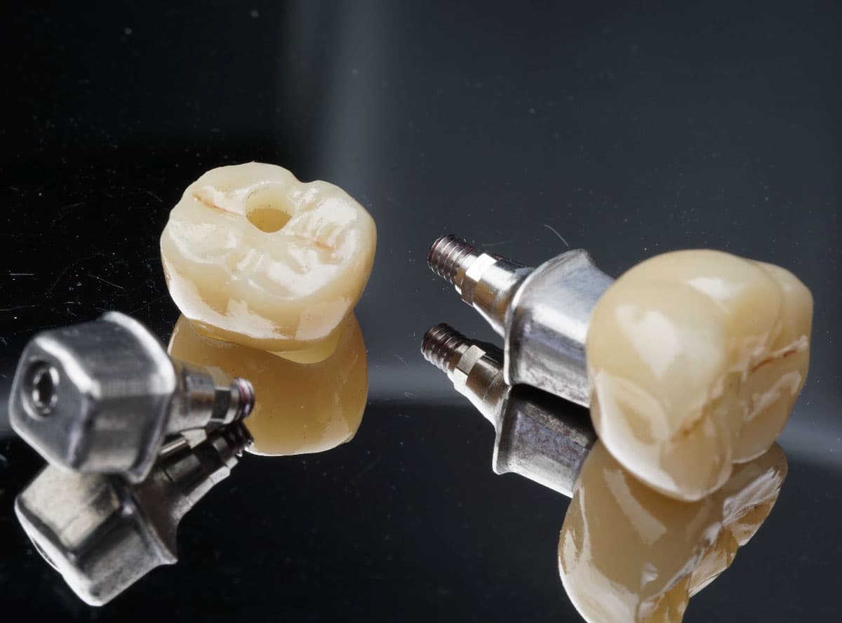 Screw-Retained Implant Crown